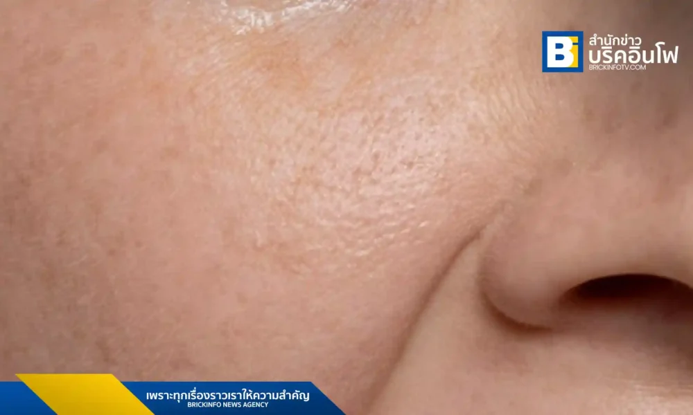 ค้นพบ 5 วิธีรักษาฝ้าลึกด้วยตัวเองที่ทำได้ง่ายและเห็นผลจริง ทั้งการใช้ผลิตภัณฑ์ลดเม็ดสี การปกป้องผิวจากแสงแดด การบำรุงจากภายใน และการจัดการความเครียด เพื่อผิวหน้าที่กระจ่างใสและสุขภาพดี