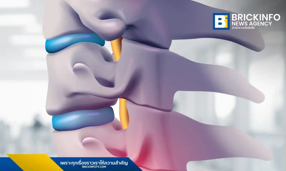 แพทย์ผู้เชี่ยวชาญจากโรงพยาบาลเอส สไปน์ แอนด์ จอยท์ เผยสาเหตุใหม่ของหมอนรองกระดูกปลิ้น ที่ไม่ได้เกิดจากการยกของหนักเท่านั้น แต่ยังมาจากผนังกั้นหมอนรองกระดูกที่บางตั้งแต่กำเนิด ซึ่งอาจทำให้เกิดอาการได้เร็วขึ้น ควรสังเกตอาการและรีบปรึกษาแพทย์หากมีประวัติครอบครัวหรือเริ่มมีอาการผิดปกติ