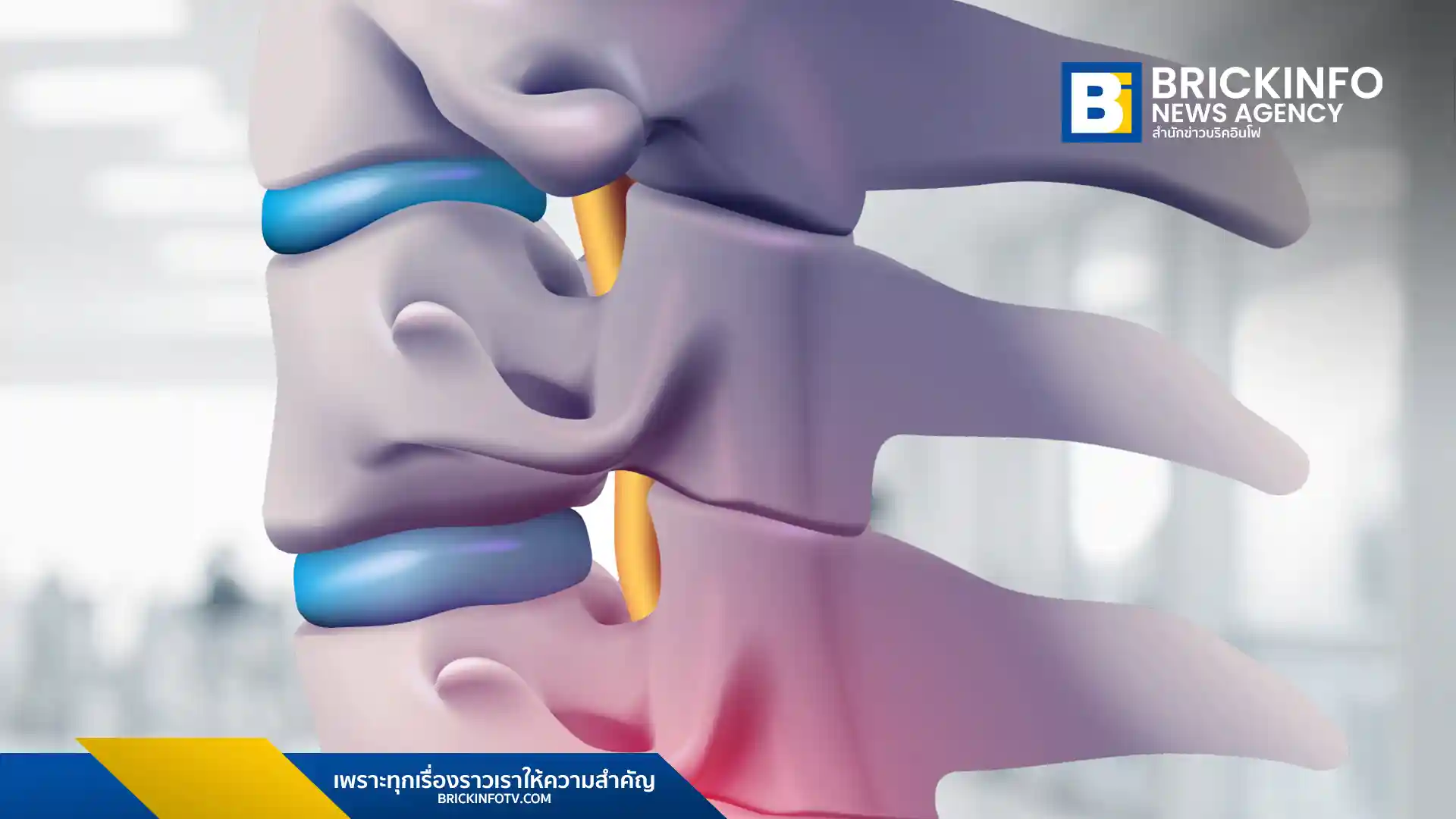 แพทย์ผู้เชี่ยวชาญจากโรงพยาบาลเอส สไปน์ แอนด์ จอยท์ เผยสาเหตุใหม่ของหมอนรองกระดูกปลิ้น ที่ไม่ได้เกิดจากการยกของหนักเท่านั้น แต่ยังมาจากผนังกั้นหมอนรองกระดูกที่บางตั้งแต่กำเนิด ซึ่งอาจทำให้เกิดอาการได้เร็วขึ้น ควรสังเกตอาการและรีบปรึกษาแพทย์หากมีประวัติครอบครัวหรือเริ่มมีอาการผิดปกติ